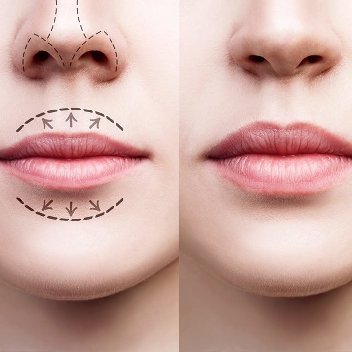 1ml lips Dermal Fillers