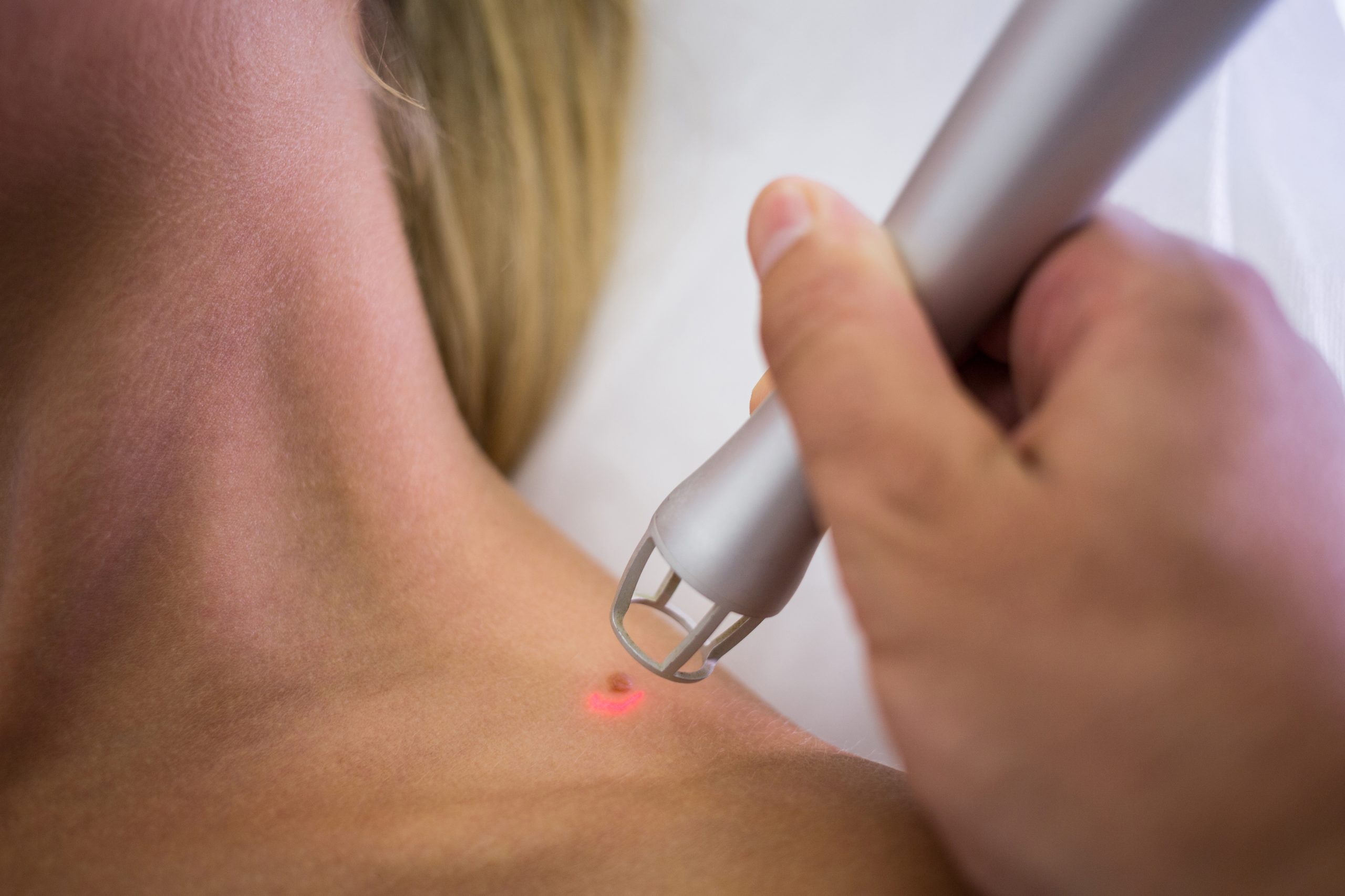 Scar Removal Microneedling
