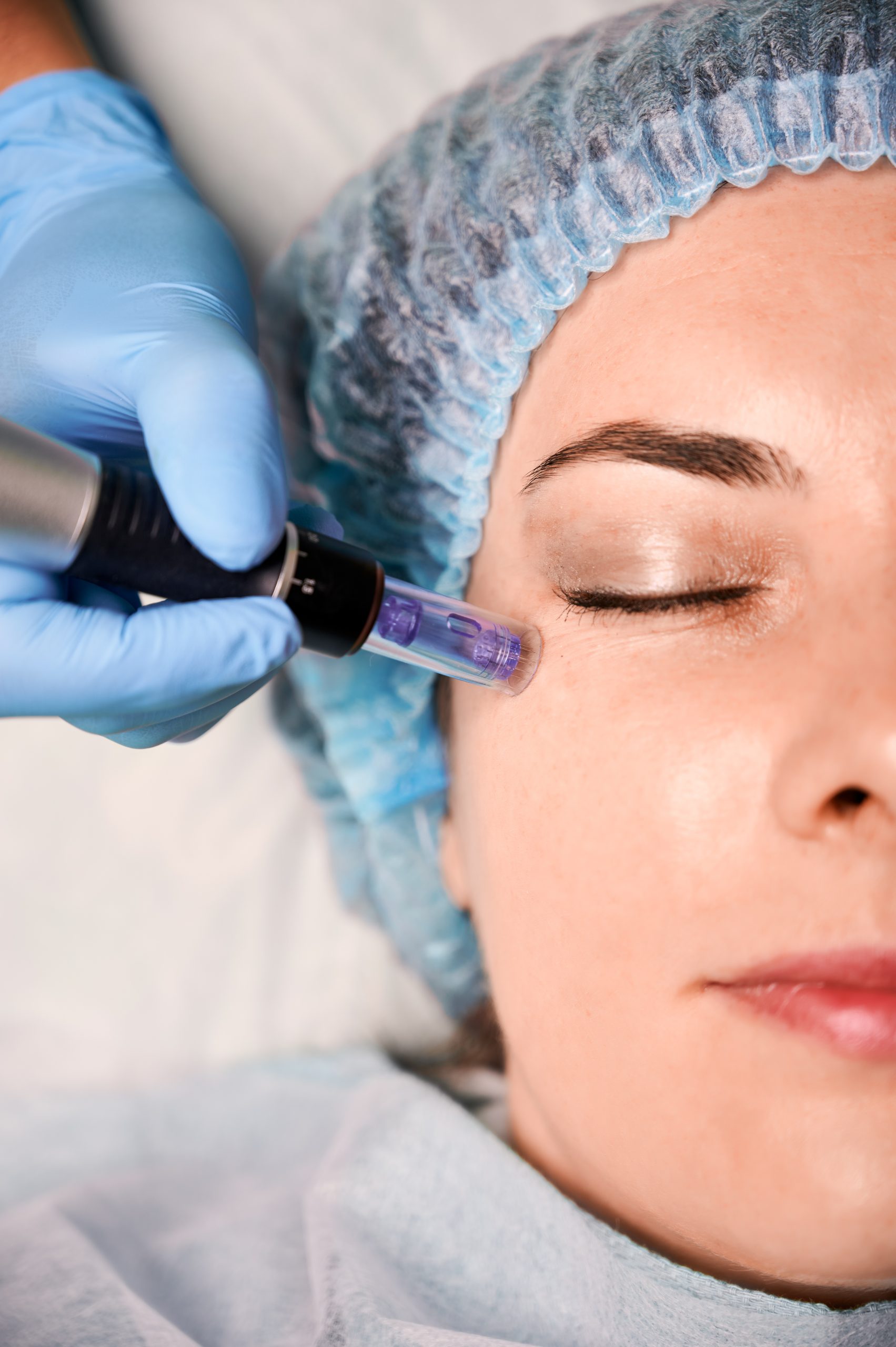 Luxury Microneedling with NCTF HA Serum, (3 Sessions pack)