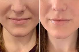 1ml Nasolabial Dermal Fillers