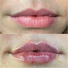 0.5ml lips Dermal Fillers
