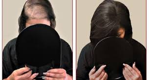 Hair replacement system